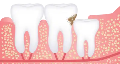 wisdom teeth removal in chennai 