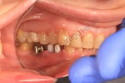 zirconia implant in india