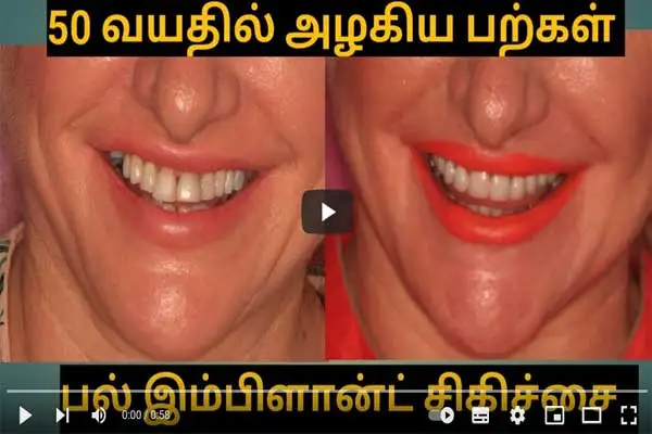 50 வயதில் அழகான பற்கள் பெற பல் இம்பிளான்ட் சிகிச்சை / Beautiful teeth at 50 with implants #shorts